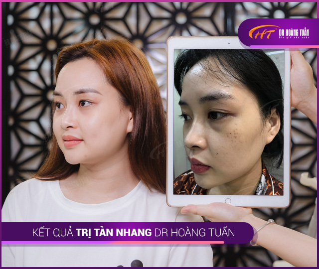 Kết quả trị tàn nhang tại Thẩm mỹ Hoàng Tuấn